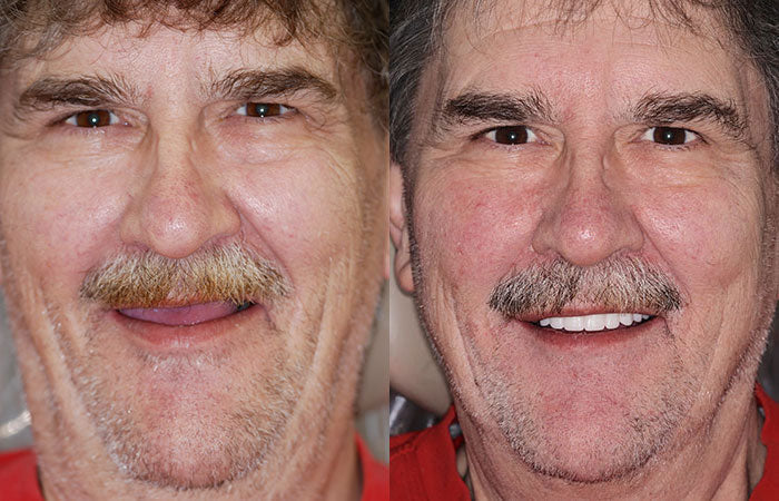 Comfort-Fit Flexible Dentures – Natural Look Easy Wear & Removal - 50% OFF