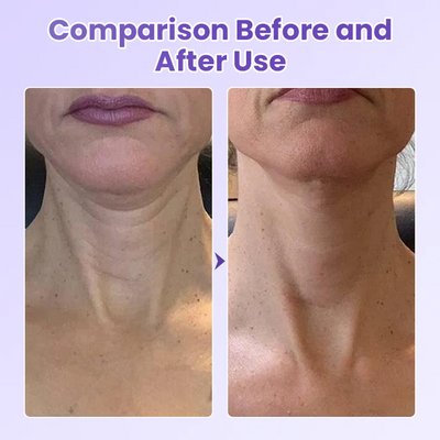 AuraLift Neck Patch - A Youthful, Sculpted Neck + 50% OFF