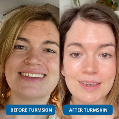 The TurmSkin Ultra Hydrating Serum - A Youthful Glow, Without the Clinic + 50% OFF
