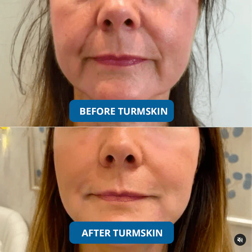 The TurmSkin Ultra Hydrating Serum - A Youthful Glow, Without the Clinic + 50% OFF