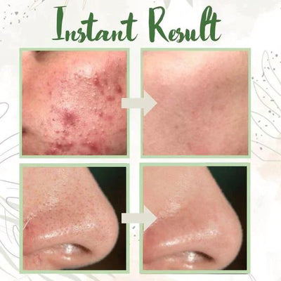 GreenCleanse Stick – Effortlessly Purify Your Skin & Reveal Your Natural Radiance - 50% OFF