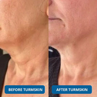 The TurmSkin Ultra Hydrating Serum - A Youthful Glow, Without the Clinic + 50% OFF