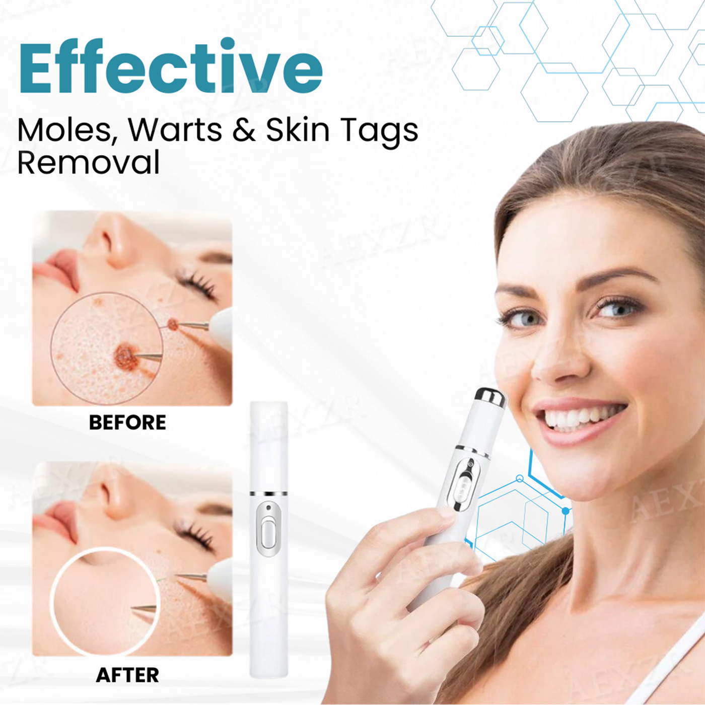 SkinRenew Pro Laser Pen - Non-Invasive Mole & Wart Removal Tool – 50% OFF