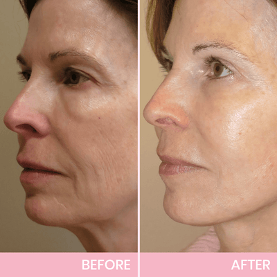 Instant V-Lift Tape – Lift Years Off Instantly! - 60% OFF