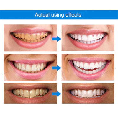 Ivory™ Teeth Whitening Essence (Limited Time Offer 50% Discount)