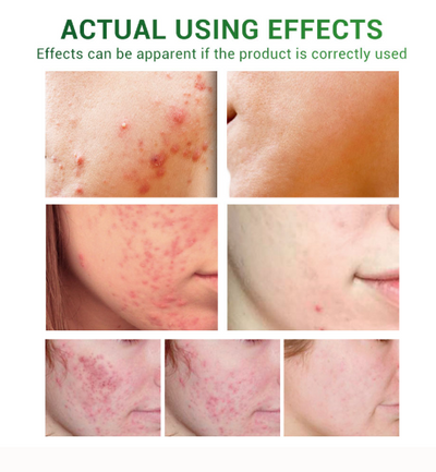 RadiantClear - Achieve Visibly Clearer, Healthier Skin and Reclaim Your Confidence 50 % OFF