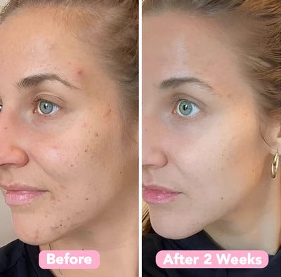 The Turmeric & Kojic Acid Glow Pads - Fade Dark Spots, Effortlessly + 50% OFF