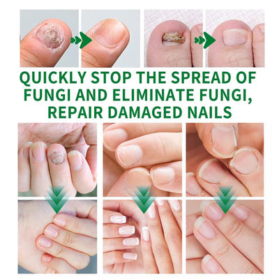 Zingiber Nail - Ginger Nail Treatment Nail