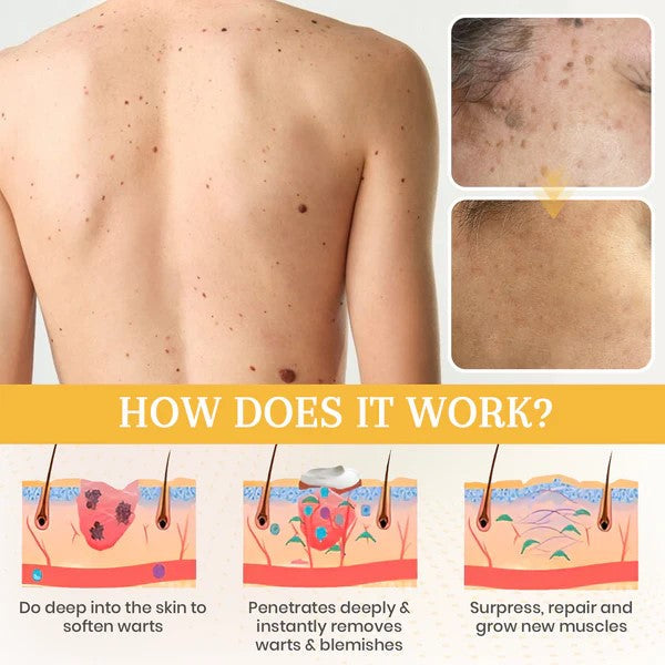 ClearSkin Erase Gel – Target Dark Spots, Moles & Blemishes with Precision - 50% OFF