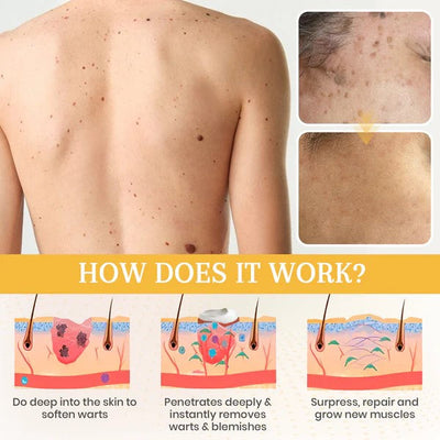 ClearSkin Erase Gel – Target Dark Spots, Moles & Blemishes with Precision - 50% OFF