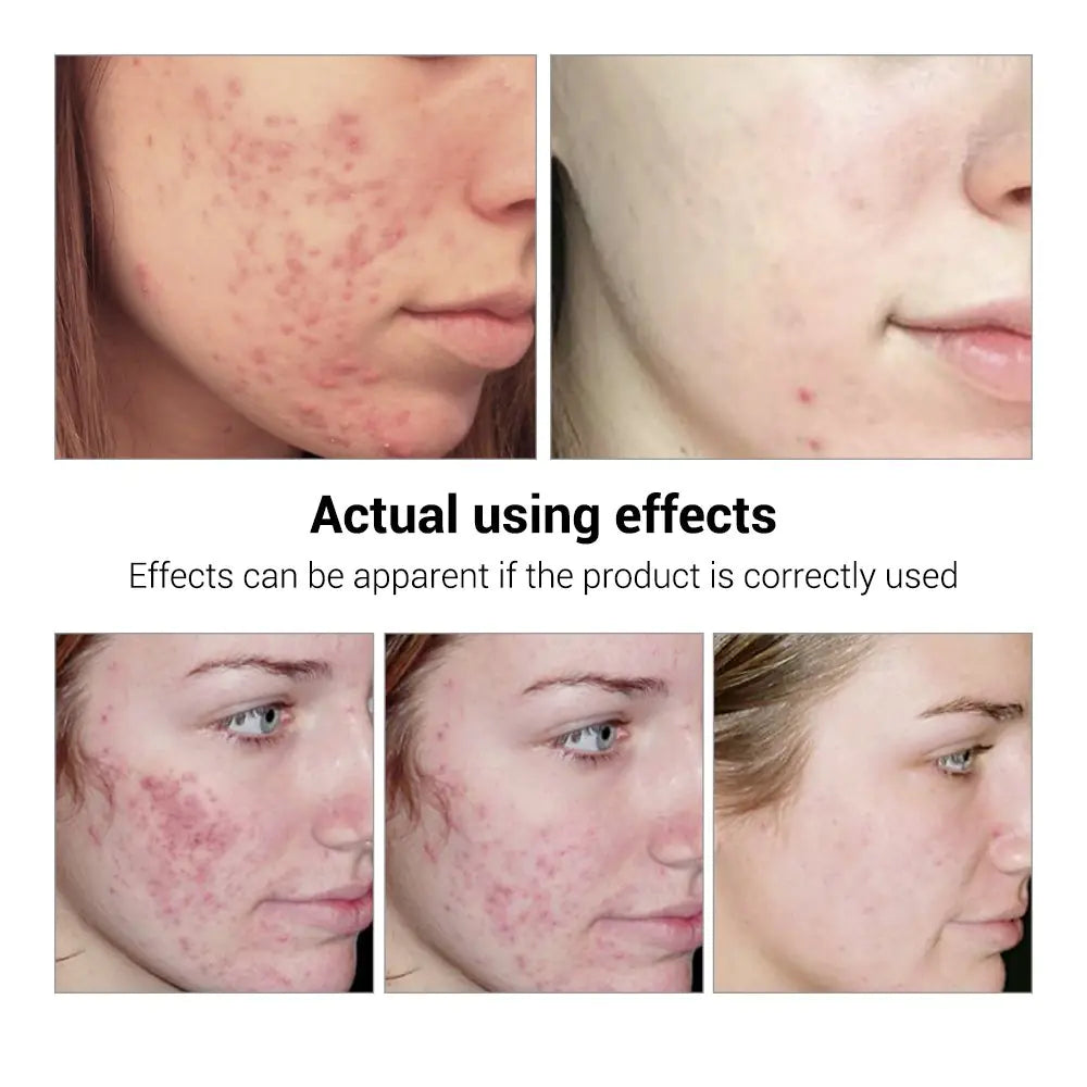 RadiantClear - Achieve Visibly Clearer, Healthier Skin and Reclaim Your Confidence 50 % OFF